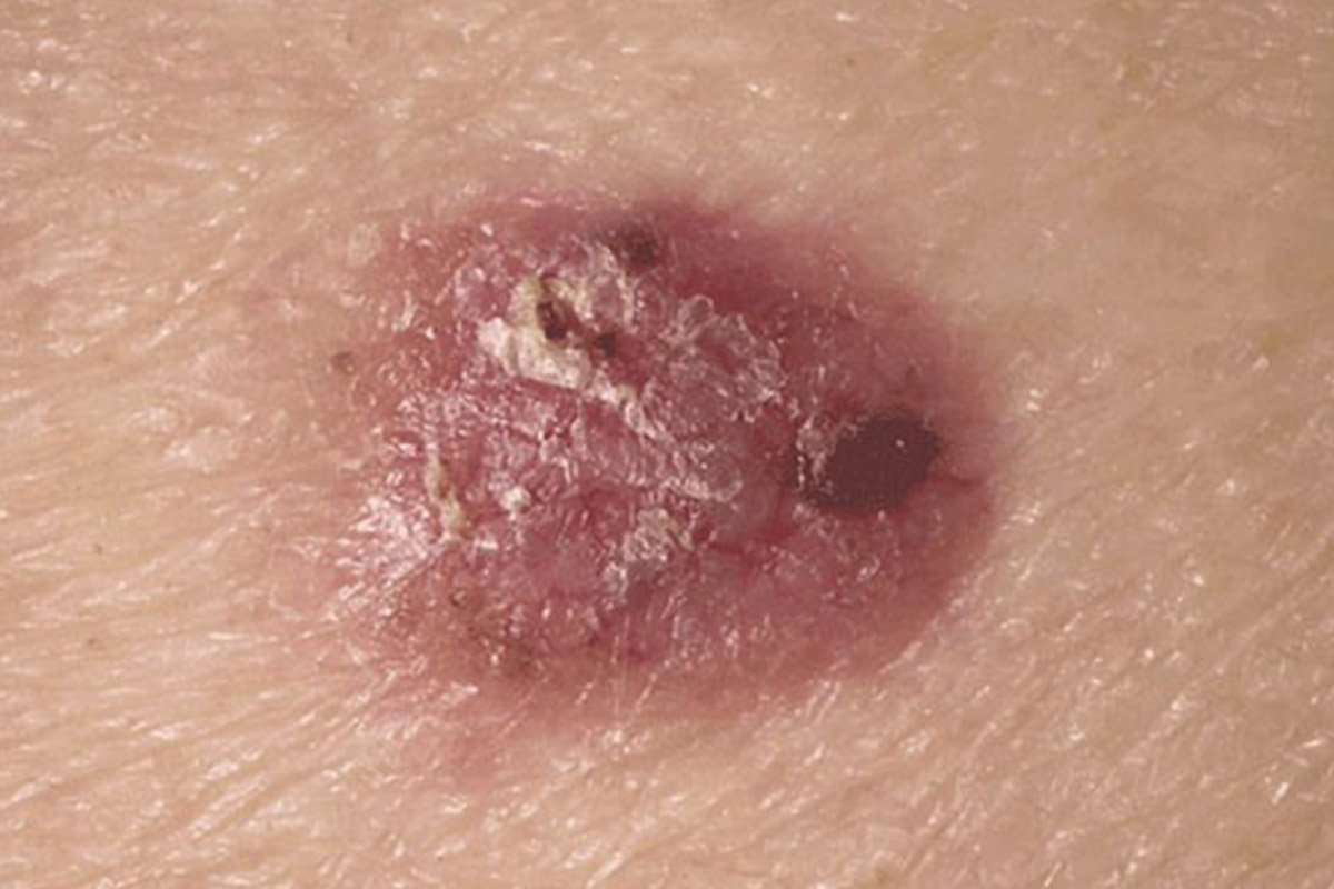 Câncer de pele não melanoma