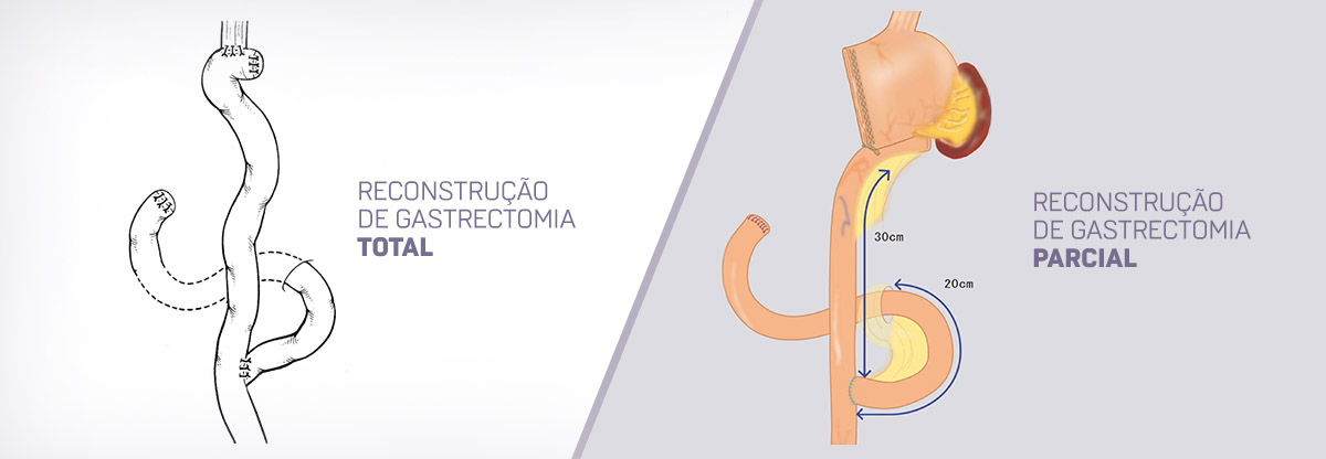 Reconstrução de Gastrectomia